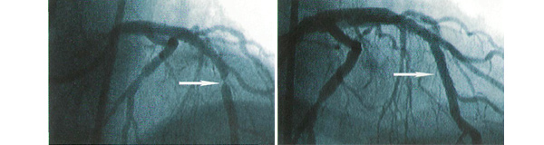 Ангиограмма до- и спустя 2 года после имплантации стента СУРНЕR