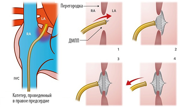Этапы эндоваскулярной имплантации окклюдера ДМПП