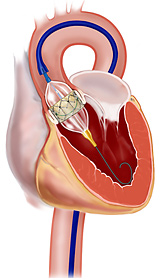 Протезирование аорторального клапана