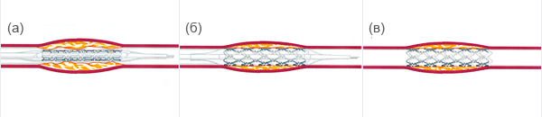 Имплантация коронарного стента