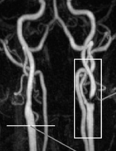 Диагностика стенозов сонных артерий