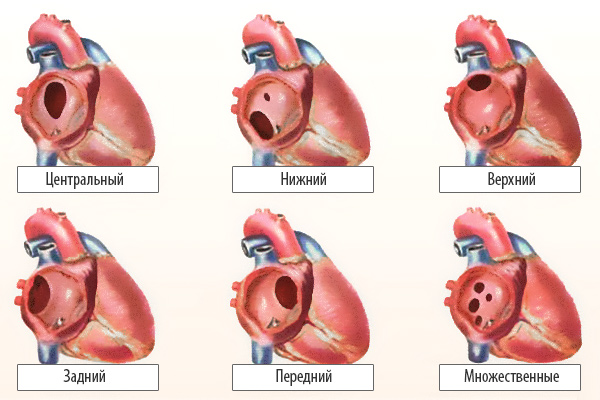 Варианты дефектов межпредсердной перегородки