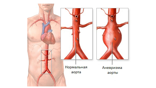 Аневризма брюшного отдела аорты