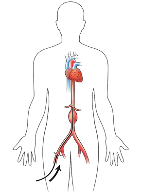 Внутрисосудистое протезирование брюшного отдела аорты (EVAR)