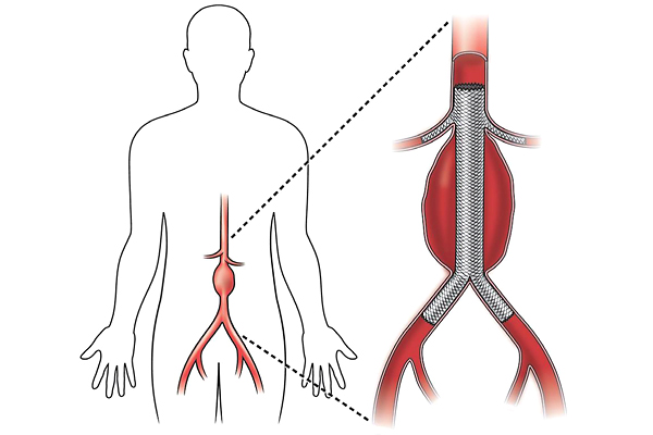 Внутрисосудистое протезирование брюшного отдела аорты (EVAR)