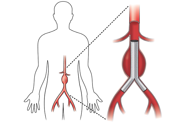 Внутрисосудистое протезирование брюшного отдела аорты (EVAR)