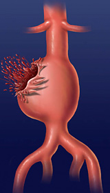 Разрыв аневризмы аорты
