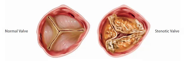 Слева: клапан без паталогии. Справа: стеноз аортального клапана