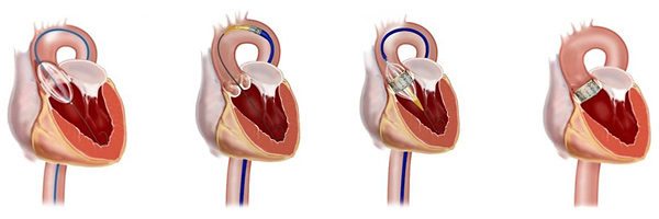 Транскатетерная имплантация аортального клапана