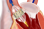 Транскатетерная имплантация аортального клапана (TAVI)