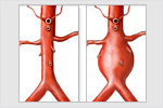 Эндоваскулярное протезирование брюшного отдела аорты (EVAR)